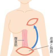 腹直筋皮弁法