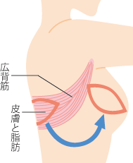 広背筋皮弁法